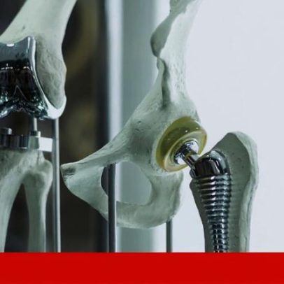 ISQ lidera projeto de implantes criados com IA e impressão 3D
