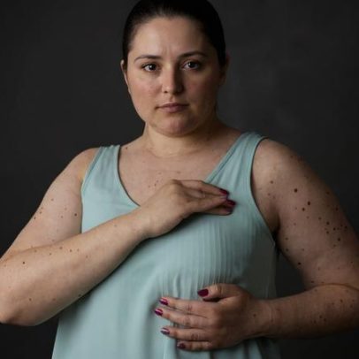 Estudo liga peso e fraqueza muscular ao risco de linfedema no cancro da mama