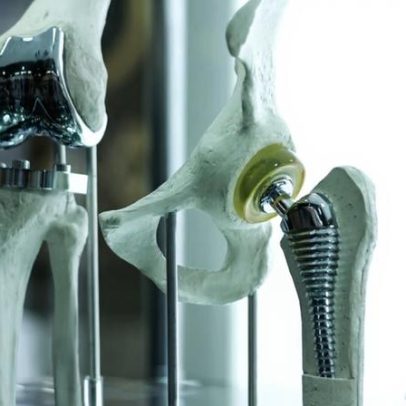 ISQ lidera projeto europeu com impressão 3D e IA em implantes ortopédicos