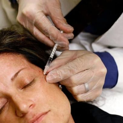 Injeções faciais com ADN de esperma de peixe ganham atenção na estética
