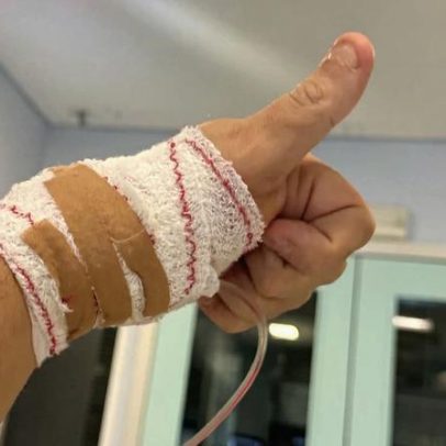 Nuno Markl começa a recuperar o controlo do braço
