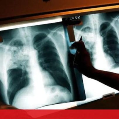 Algoritmos da OMS podem duplicar diagnósticos de tuberculose em crianças
