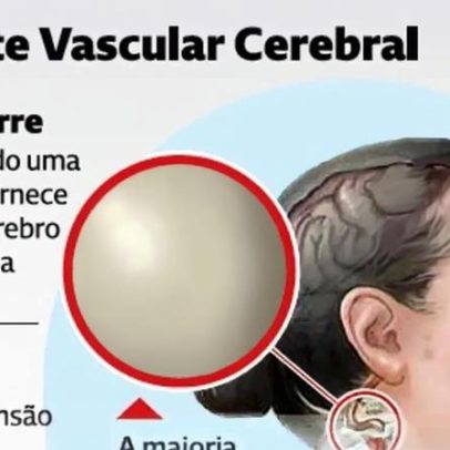 AVC: como ocorre, causas, sintomas e tratamento