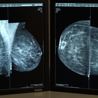 60 mil casos de cancro em 2022: mama, colorrectal, próstata e pulmão