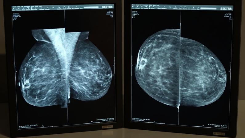 60 mil casos de cancro em 2022: mama, colorrectal, próstata e pulmão