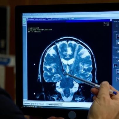 Pesquisa revela novos dados sobre morte celular em doença neurodegenerativa