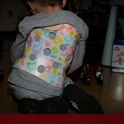 Menino de 4 anos com o coração do lado errado não detetado pelos médicos