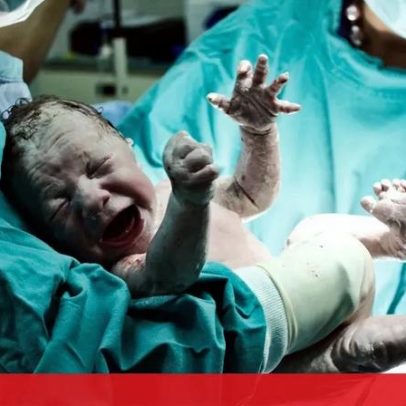 Cesarianas já representam um terço dos partos no SNS
