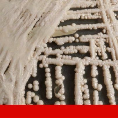 Primeiros casos de Candida auris em Portugal ressaltam necessidade de vigilância