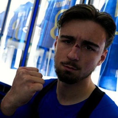FC Porto mostra nariz partido de Martim Fernandes e considera detalhe