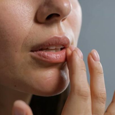 Cieiro persistente: dermatologista explica diferenças entre condições oculares