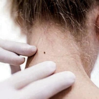 Nova vacina contra o cancro da pele reduz 49% o risco de melanoma