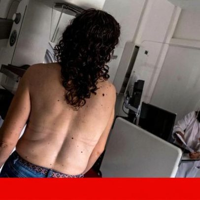 SNS paga 20,5 euros por mamografia; ADSE paga o dobro e afasta prestadores