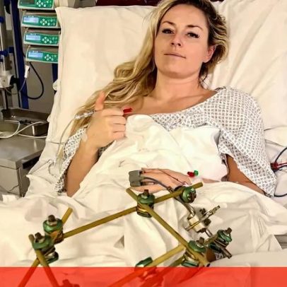 Lindsey Vonn opera pela terceira vez a perna; estado da atleta
