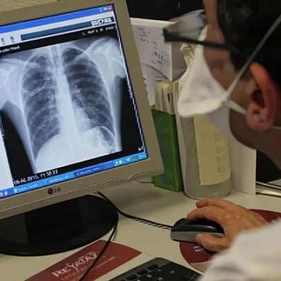 Sociedade alerta para défice de proteína em algumas doenças respiratórias