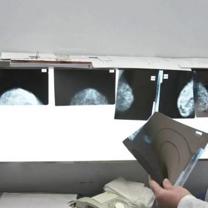 SNS paga metade dos valores da ADSE a radiologia conveniada