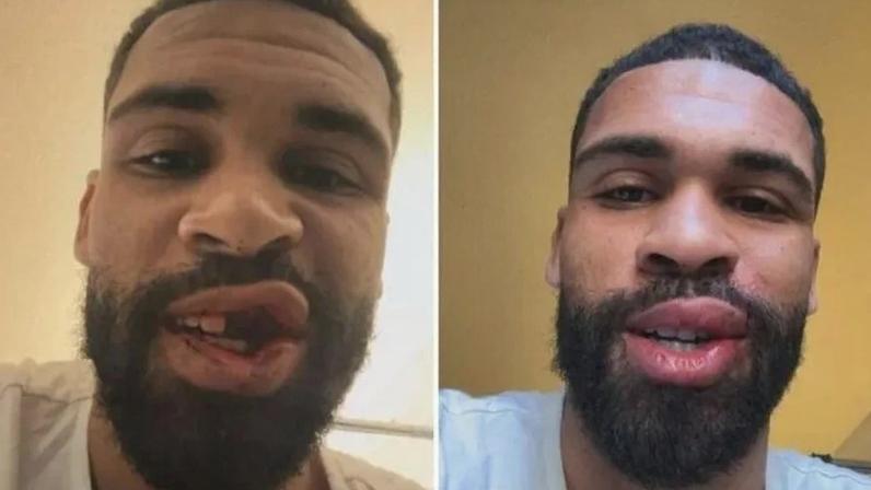 Loftus-Cheek operado após fratura no maxilar em jogo do Milan com o Parma