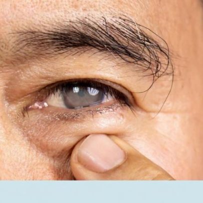 Alerta para o glaucoma: tudo o que precisa saber hoje