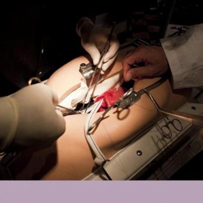 Lipoproteína(a): marcador esquecido que pode mudar a prevenção cardiovascular