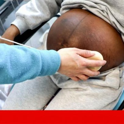 SNS bate recorde de cesarianas em 2025; Norte e Alentejo com piores resultados