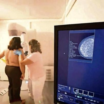 ADN tumoral no sangue pode prever recidiva do cancro da mama