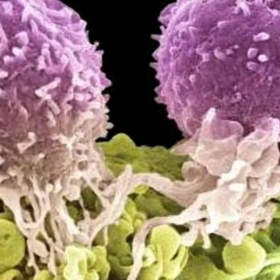 Menopausa pode criar ambiente na mama que favorece células cancerígenas