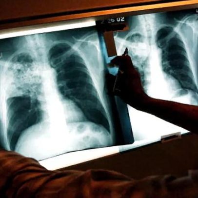 Portugal é terceiro na Europa em tuberculose infantil até 4 anos