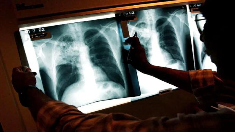 Tuberculose continua a matar em Portugal