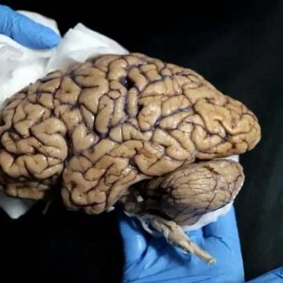 Associação alerta para falta de respostas a vítimas de danos cerebrais adquiridos