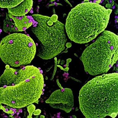 Organização defende reconhecimento clínico e institucional da covid longa