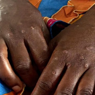 Mais dez portugueses diagnosticados com varíola dos macacos