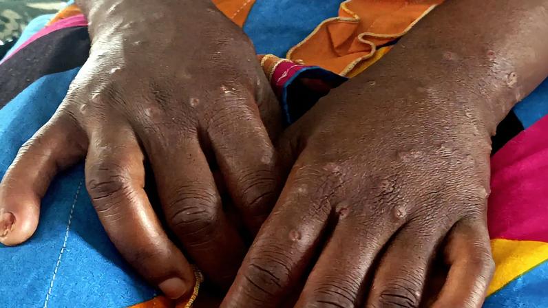 Mais dez portugueses diagnosticados com varíola dos macacos