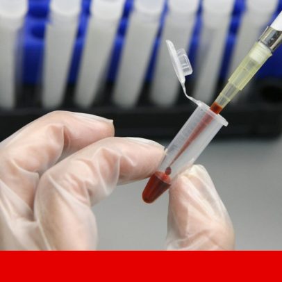 Análise de sangue revela resultados promissores na detecção da endometriose