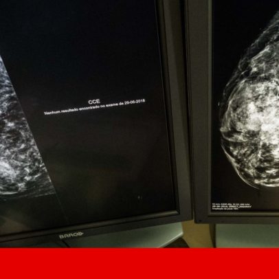 Menopausa pode criar ambiente na mama que favorece células cancerígenas
