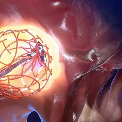 Cateter inovador visa revolucionar tratamento de arritmia