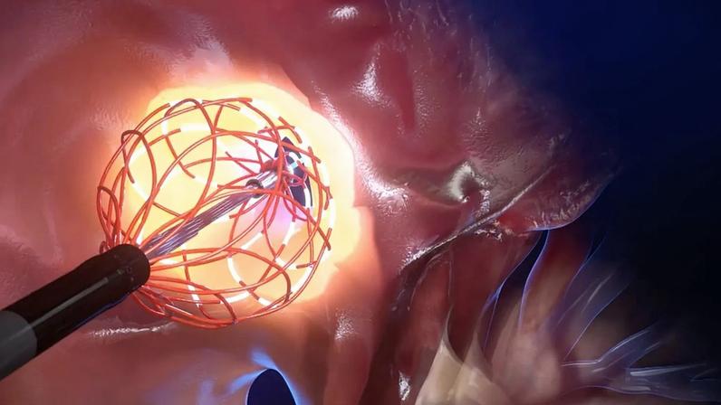 No fundo do coração: o cateter inovador concebido para revolucionar o tratamento da arritmia