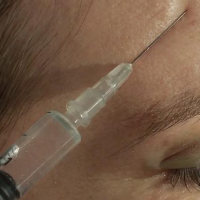 Alerta sobre riscos do Botox e ácido hialurónico por quem não está habilitado