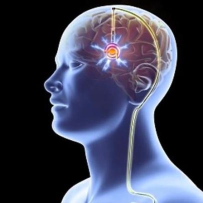 Parkinson em jovens: a vida pode tornar-se imprevisível em dias comuns