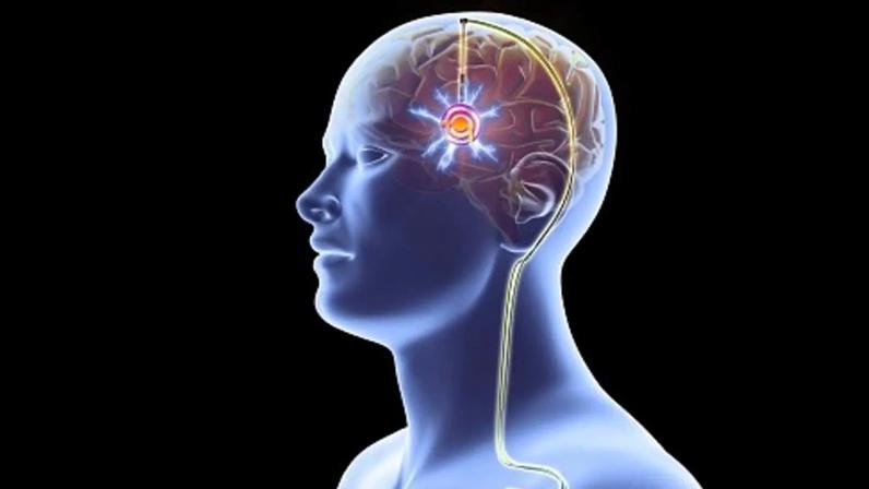 Doença de Parkinson