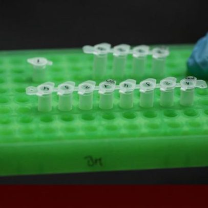 Teste genético pode acelerar tratamento do câncer da bexiga metastático