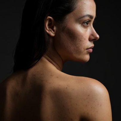 Acne nas costas e peito é comum mas frequentemente subestimada