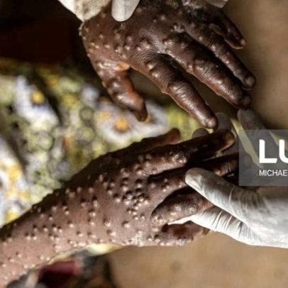 Prevenção reforçada na província do Zaire após caso de mpox no Uíge