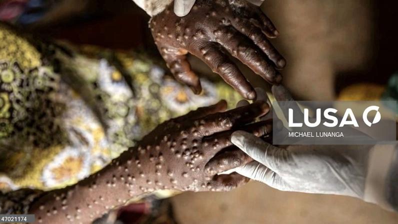 Prevenção reforçada na província do Zaire após caso de mpox no Uíge
