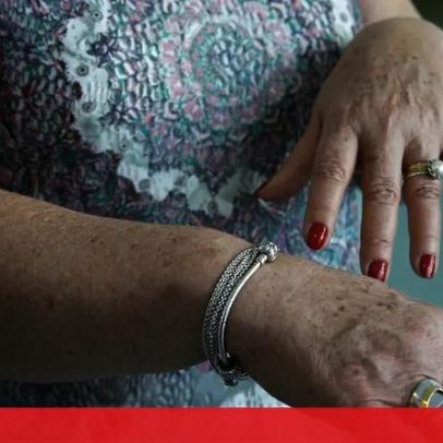 Angioedema hereditário afeta portugueses e pode ser confundido com alergia
