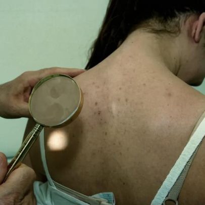 66% dos pacientes oncológicos vivos cinco anos após diagnóstico