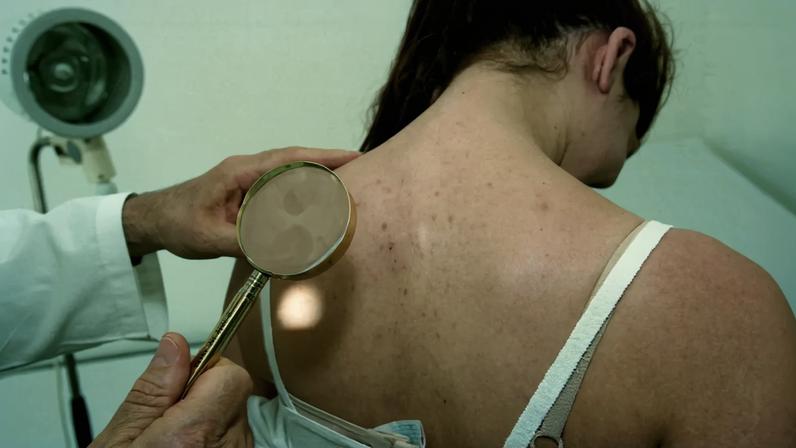 Diagnóstico precoce é chave. O cancro da pele tem 81,7% de taxa de sobrevivência