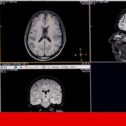 Estudo com mão portuguesa mapeia risco cerebral de doenças psiquiátricas