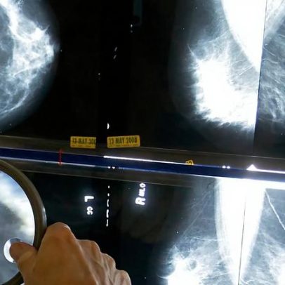 Espanha identifica 111 casos de cancro raro ligado a implantes mamários