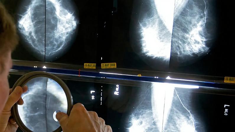 Espanha identifica 111 casos de cancro raro ligado a implantes mamários