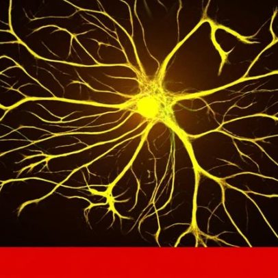 Síndrome de Down: degeneração cerebral identificada desde o nascimento